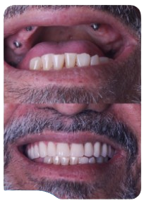 Imagem de um implante.